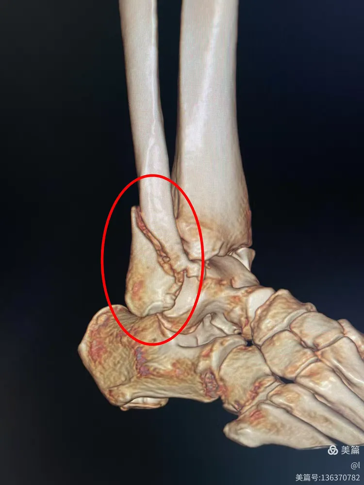 冕宁漫水湾友松医院放射科～外伤ct三维重建篇